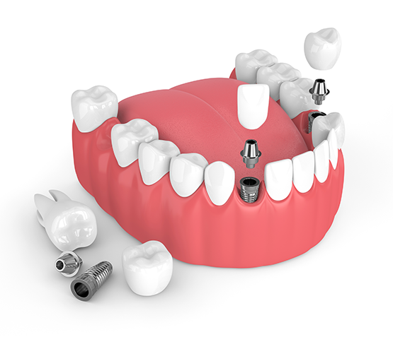 Dental Implants Murrells Inlet